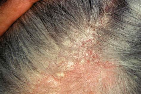 Dermatite Séborrhéique Symptômes Complications Et Plus Encore