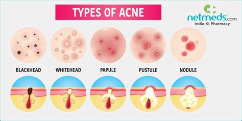 Types Of Acne Know The Difference Between Blackheads Whiteheads