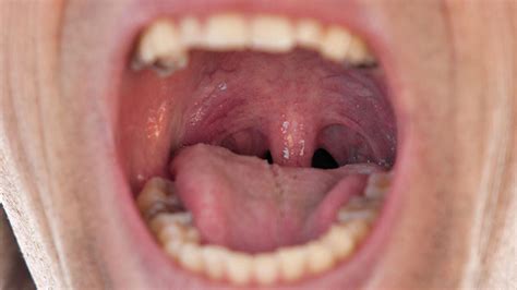 What Does Throat Cancer Look Like Images Throat Cancer High