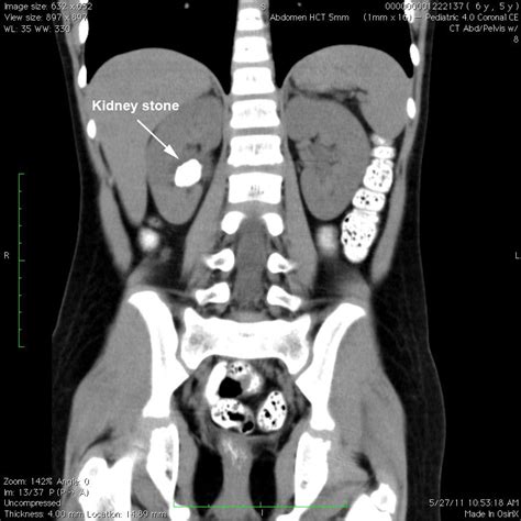 Kidney Stone Cat Scan