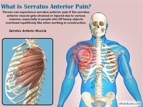 Serratus Anterior Myofascial Pain Syndrome