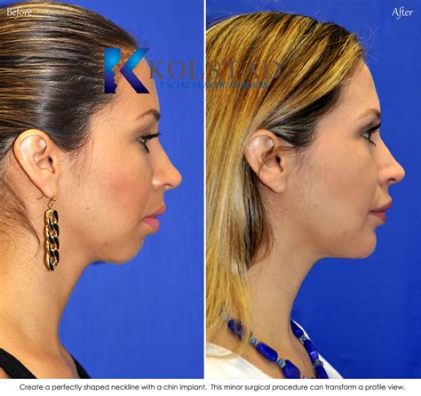 Chin Augmentation San Diego 305 Copy Dr Kolstad San Diego Facial