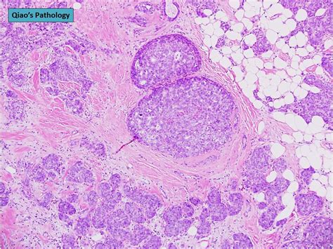 Qiaos Pathology Solid Papillary Carcinoma Of The Breast With