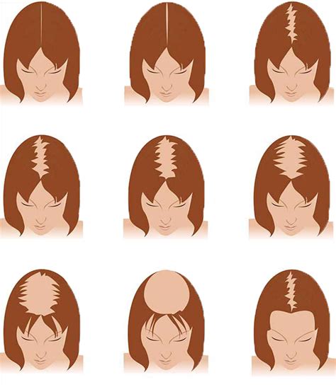 Female Hair Loss Solutions Hair Loss Treatment For Women Hairlogica