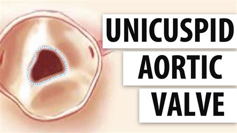 Unicuspid Aortic Valves Top 5 Facts Patients Should Know Youtube