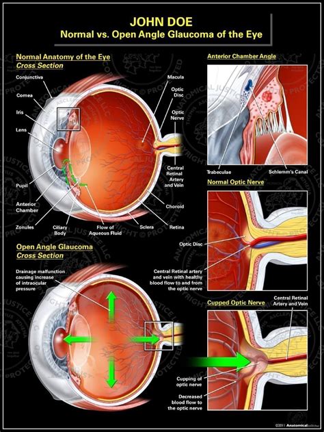 Normal Vs Open Angle Glaucoma Of The Eye