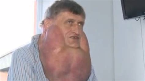 Massive Tumor Removed From Mans Face