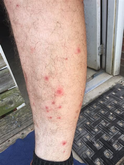 Rashes That Look Like Scabies Causes Symptoms And 55 Off