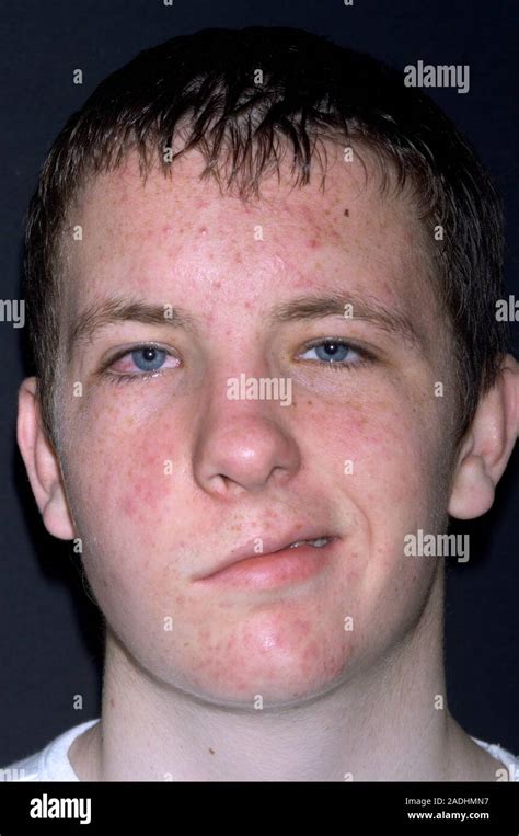 Facial Palsy Due To Nerve Damage After The Removal Of A Neurofibroma