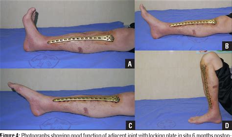 Figure 4 From Treatment Of Segmental Tibial Fractures With