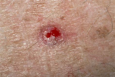 Basal Cell Carcinoma On Skin On The Back Stock Image M1310244