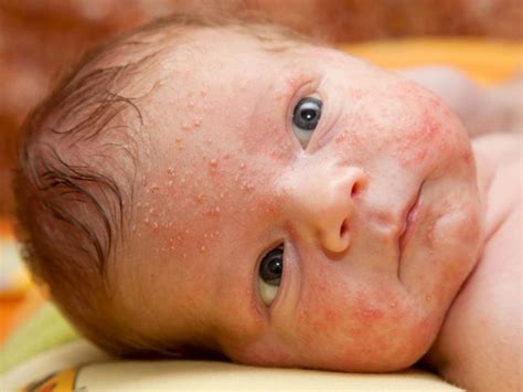 حساسية الجلد عند الاطفال الرضع