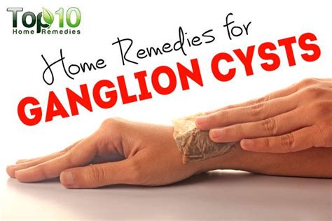 Home Remedies For Ganglion Cysts Page 2 Of 3 Top 10 Home Remedies