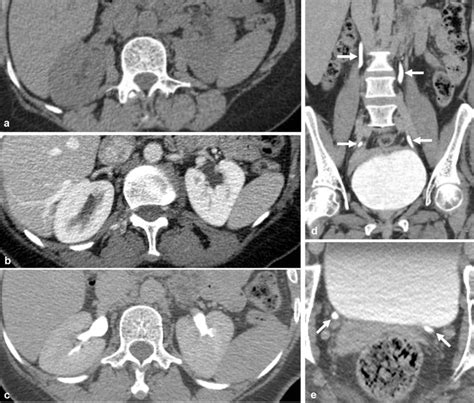 Normal Appearance Of The Three Phases Of Ct Urography Is Provided For