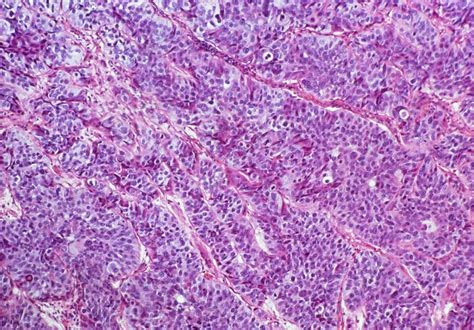Lm Of Transitional Cell Carcinoma Of Bladder Stock Image M1320447