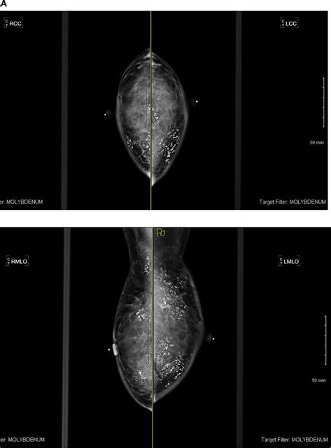 A Mammogram From November 2015 Cc And Mlo Views B Mammogram From