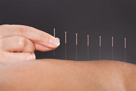 5 Unexpected Health Benefits Of Acupuncture