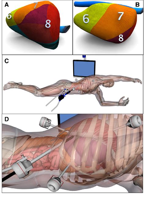 Laparoscopic Liver Resection In The Semiprone Position For Tumors In
