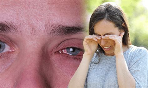 Red Eye Six Common Causes Of Red Eyes And When To Seek Help Express