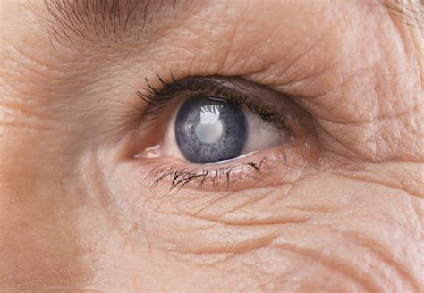 6 Early Signs Of Glaucoma What You Need To Know