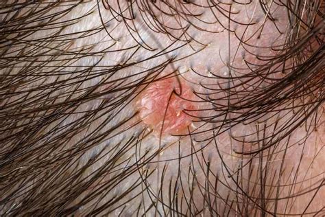 A skin tag is a small piece of soft, hanging skin that may have a peduncle, or stalk. The Mystery of the Skin Tag on Scalp- Explained