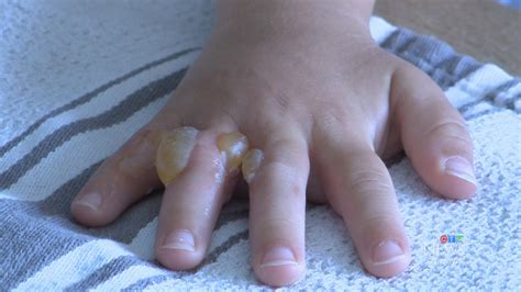 Four Year Old Boy Suffers Painful Burn From Wild Parsnip Ctv News