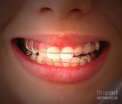 Removable Orthodontic Braces Photograph By Oscar Burriel Science Photo Library Fine Art America