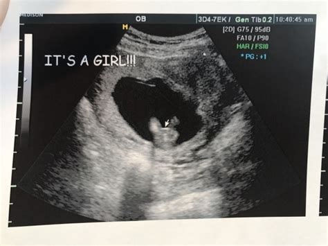 14 Week Gender Ultrasound Glow Community