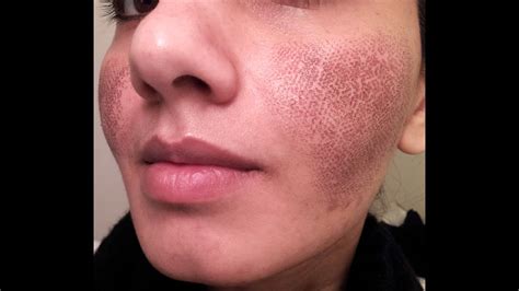 Before And After My Fraxel Laser Experience For Acne Spots And Large Pores