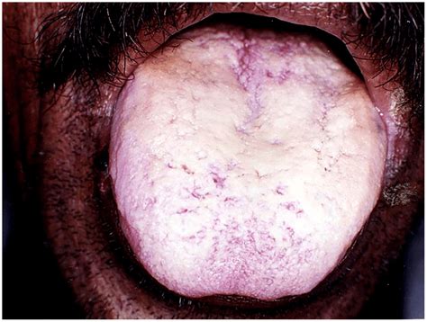 Pseudomembranous Candidiasis Of The Tongue The Copyright Of The