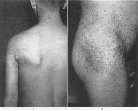 Reversible Calcinosis Cutis — Calciphylaxis In Man Nejm