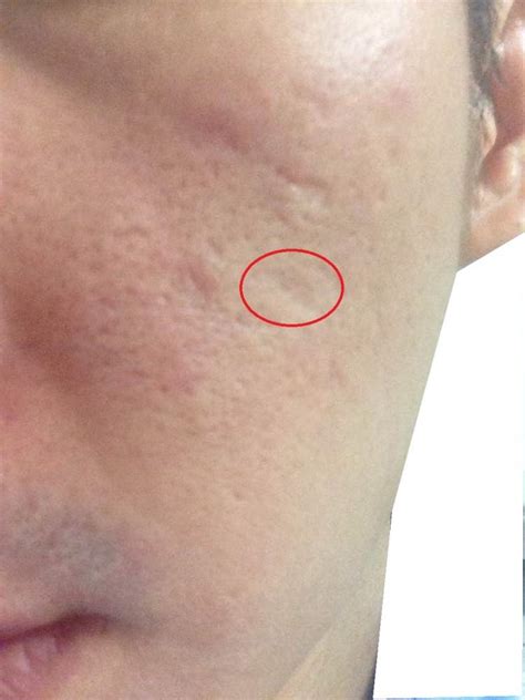 Deep Rolling Scar Due To Large Cyst Acne Dermaflage On Left Cheek