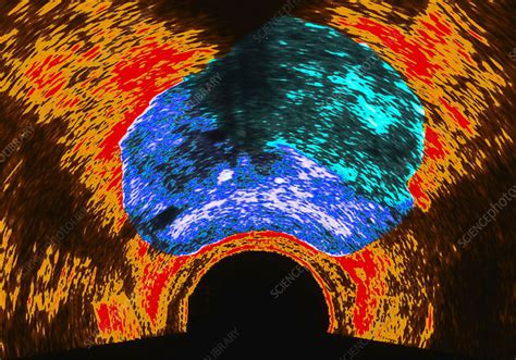 Prostate Cancer Ultrasound Scan Stock Image C0309272 Science Photo Library