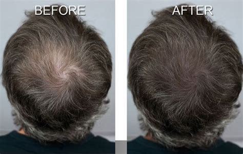 In this post, we will share a number of hairstyles tips to follow to create a stylish look and 50 best photos for your hair inspiration. Adding Smp For Density To Longer/thinning Hair ...