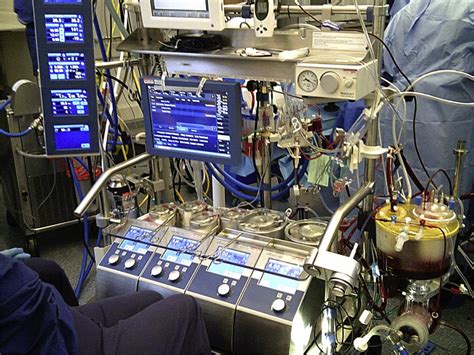 Cardiopulmonary Bypass Anaesthesia And Intensive Care Medicine