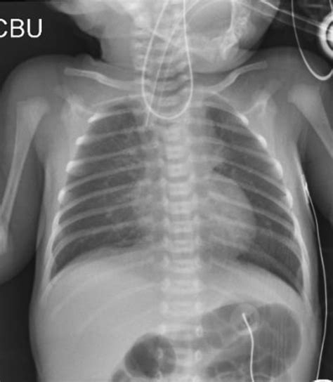 Oesophageal Atresia With Tracheo Oesophageal Fistula An Unusual