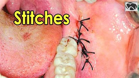 Wisdom Teeth Removal Stitches Types Of Stitches Used In Wisdom Teeth