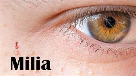 Milia Types Causes And Treatment Youtube