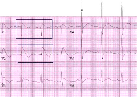 This is therefore an anterolateral st elevation mi (stemi). Brugada ECG pattern precipitated by acute pneumonia: a ...