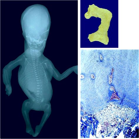 Sos Biologia Celular Y Tisular Tejidos Oseo Displasia Osea