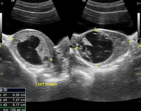 Ovarian Torsion Radiology Case Radiology