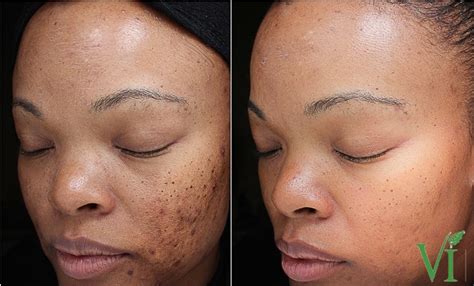 Pigment Issues Skin By Design Dermatology And Laser Center Pa