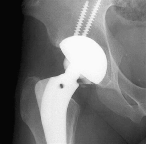 Delayed Fracture Of A Ceramic Insert With Modern Ceramic Total Hip