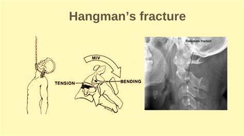 Hangmans Fracture C2 Fracture Cervical Spine Fracture Youtube