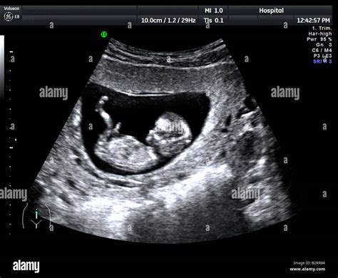12 Twelve Week Ultrasound Scan Antenatal Photo Of Unborn Foetus Baby