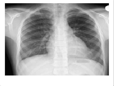 Chest X Ray With Small Infiltration On Left Side At The Apical Border