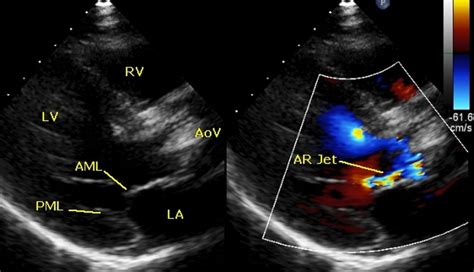 Split Screen Echocardiographic Image In Parasternal Long Axis View
