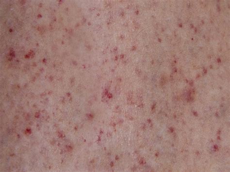 Small Red Spots On Skin Jameslemingthon Blog