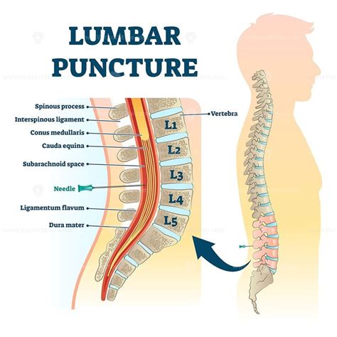 Lumbar Puncture Vector Illustration Lumbar Puncture Spinal Fluid