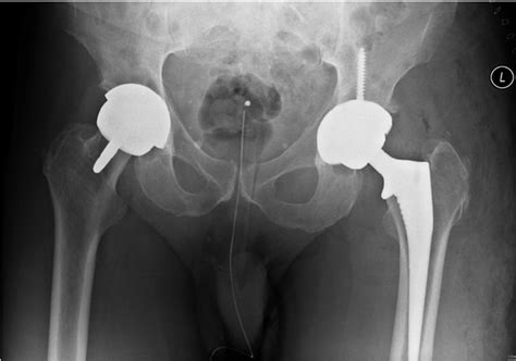 X Ray Shows A Hip Resurfacing Arthroplasty Right And A Total Hip